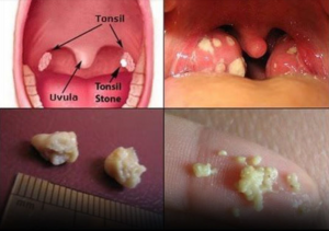 Here’s What You Need to Know About Tonsil Stones