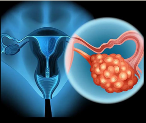 8 Early Warning Signs Of Ovarian Cancer You Shouldn’t Ignore