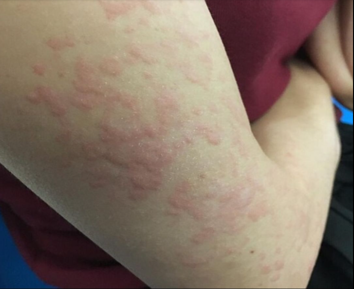 Surprising Causes Of Hives Revealed — What May Be Triggering Your Skin Reaction