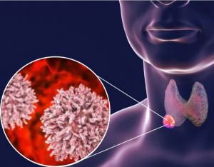 35-Year-Old Man’s Sore Throat Turned into Cancer After 5 Chemotherapy Sessions—Doctor Urges: Throw These 2 Things Out of Your Fridge