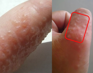 If You See These Painful Red Bumps, You May Have Dyshidrotic Eczema