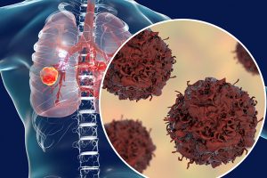The “hidden nature” of early stage lung cancer