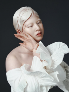 Girl abandoned at birth for her looks wants to prove the world wrong – she now models for Vogue