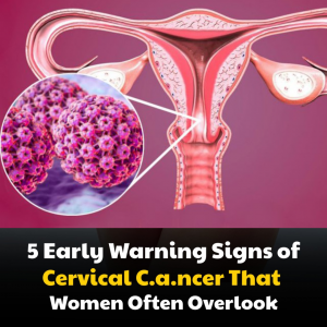 5 Early Warning Signs of Cervical Cancer Every Woman