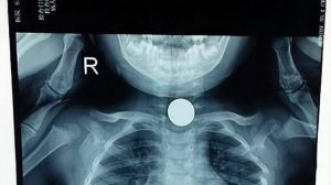 Tragedy: 3-Year-Old Girl D.i.es Suddenly While Playing With Dad Autopsy Reveals What She Swallowed