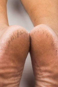 Cracked heels are not always caused by dry skin: Be aware of these conditions