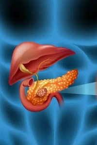 Pan.creatic can.cer: 10 early warning signs you should never ignore