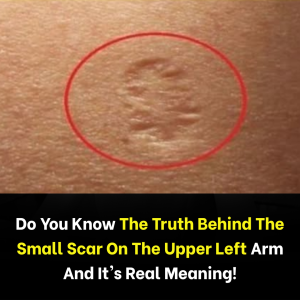 What Do Smallpox Vaccine Scars Look Like and Why Do They Form?