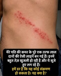 त्वचा पर एक तरफा लाल दाने और जलन: कारण, लक्षण और सही देखभाल के उपाय