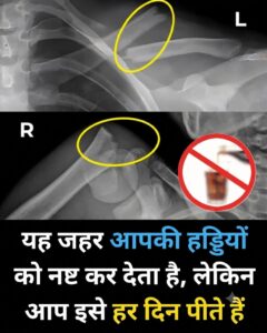 हड्डियों को अंदर से कमजोर बना रही हैं ये रोजमर्रा की ड्रिंक्स: जानिए असली कारण और बचाव के उपाय