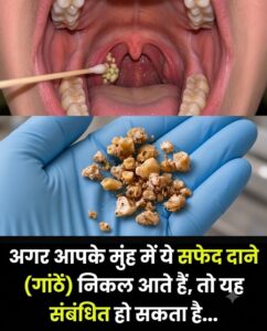 मुंह और गले में दिखने वाले सफेद दाने क्या हैं? जानिए टॉन्सिल स्टोन के कारण, लक्षण और आसान उपाय