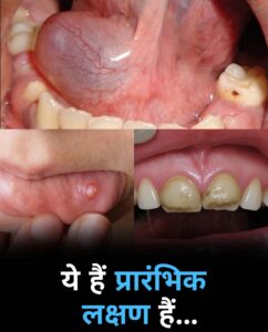 मुंह में छाले, गांठ और सूजन: कारण, प्रकार, घरेलू देखभाल और जरूरी सावधानियां