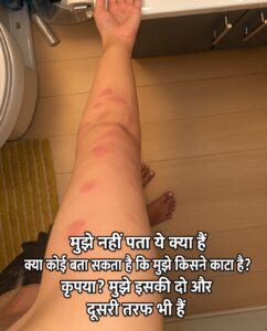 त्वचा पर अचानक उभरे लाल चकत्तों और कीड़े के काटने की पहचान कैसे करें: आसान गाइड
