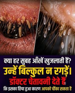 हर सुबह आँखों में तेज खुजली और पपड़ी: जानिए इसका असली कारण और आँखों की सही सफाई के उपाय