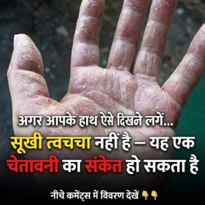 हाथों की त्वचा का अत्यधिक फटना और छिलना: यह सिर्फ रूखापन नहीं, बल्कि शरीर का एक बड़ा संकेत हो सकता है