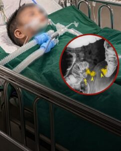 कक्षा 2 के बच्चे में कोलन क.ैं.स.र का पता चला: क्या बचपन की खान-पान की आदतें बन सकती हैं खतरा?