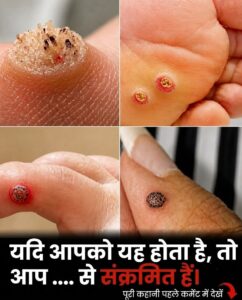 त्वचा पर काले बिंदुओं वाले सख्त दाने? जानिए वायरल वार्ट्स (मस्सों) का कारण और सुरक्षित समाधान