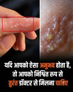 उंगलियों और हथेलियों पर पानी भरे छोटे दाने? जानिए डिस्हाइड्रोटिक एक्जिमा और हर्पीस व्हिटलॉ के कारण व तुरंत उपचार